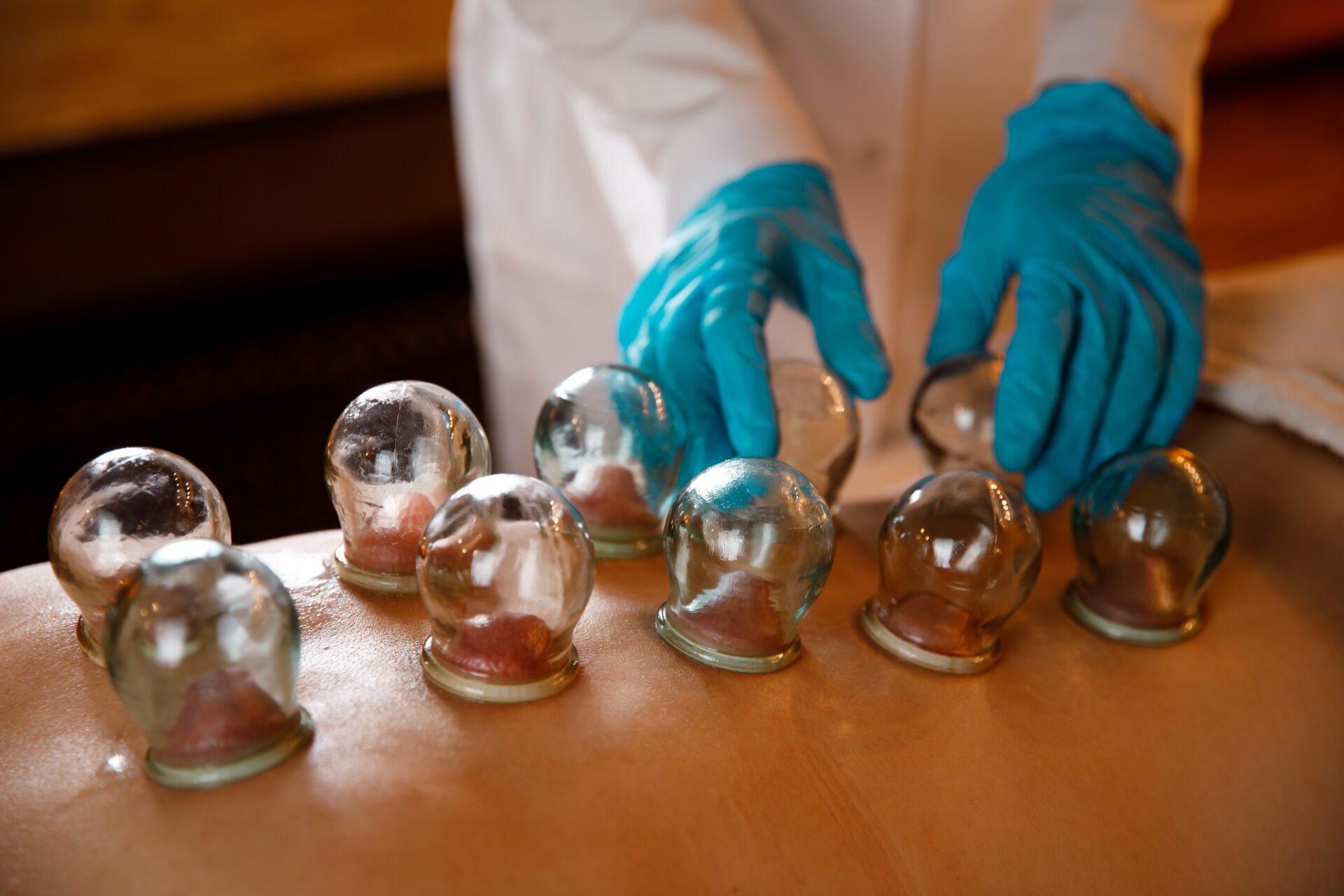 A young woman relaxes in a massage parlor. Vacuum cups of medical cupping therapy on woman back, close up, chinese medicine.